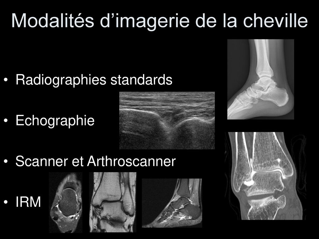 Radioanatomie de la cheville ppt t l charger